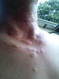 腫れて